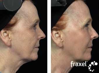 Fraxel for skin tightening before 8532