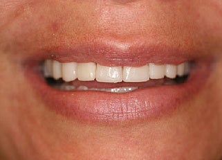 Smile makeover with Lumineers and Invisalign after 109373