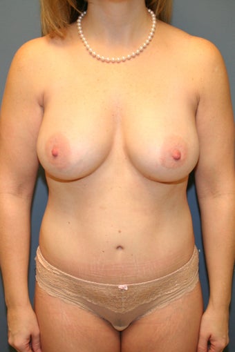 Mommy Makeover Breast augmentation and tummy tuck after 539084