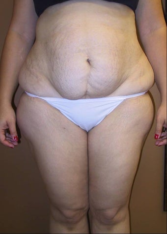body lift before 258897