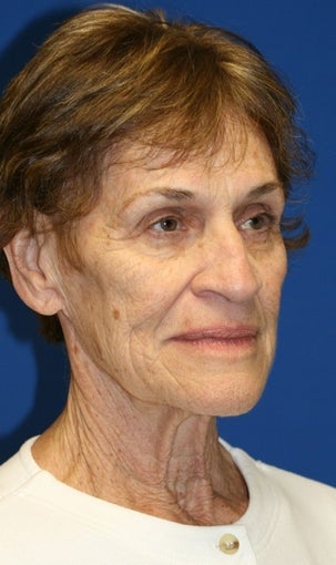 Facelift, Browlift, & Skin Pinch 540327