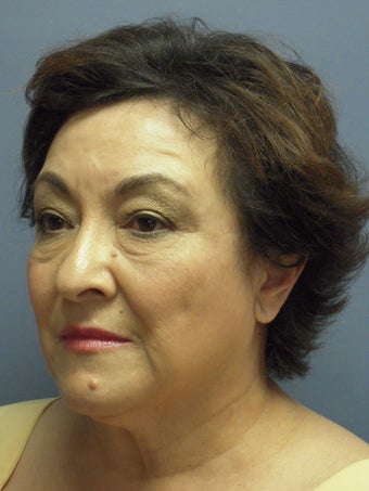 Neck Lift, Platysmaplasty 634736