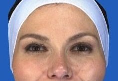 Botox Crow's Feet after 469033