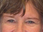 Brow Lift after 541493