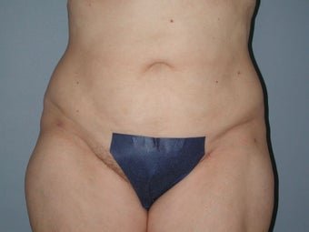 Liposuction hips, waist, upper and lower abdomen, lateral thighs after 581418