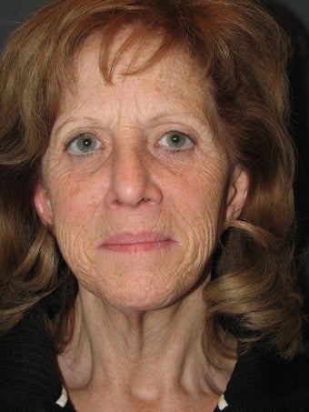 Facelift and Chemical Peel before 123603
