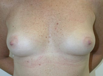 Breast Reconstruction before 526305