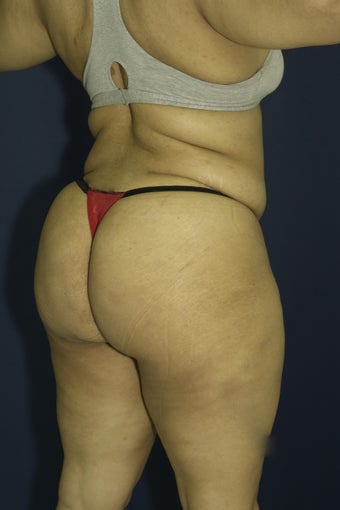 Brazilian Butt Lift surgery (liposuction to multiple areas and fat grafting to buttock) after 606611