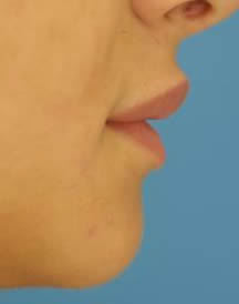 Lip Augmentation after 458991