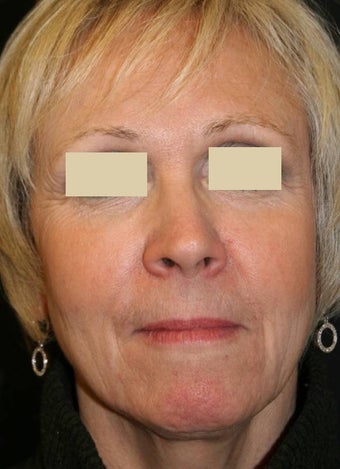 Sculptra Liquid Lift after 137157