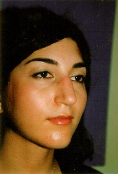 Rhinoplasty before 278369