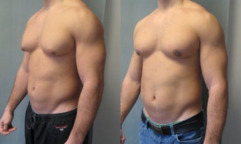 Gynecomastia New York after 349231