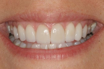 Smile Makeover with 8 Veneers after 206797