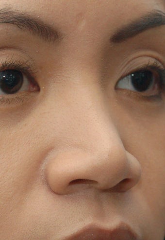 Non-Surgical Rhinoplasty before 91082