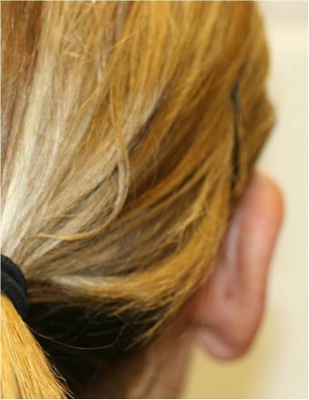 Otoplasty Unilateral (right ear) after 109838