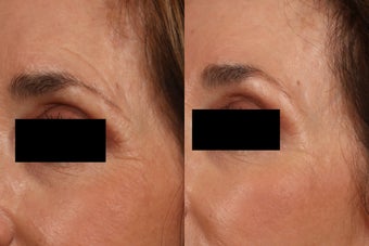 Ultherapy Eyelid Lift before 615727