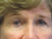 Brow Lift before 541493