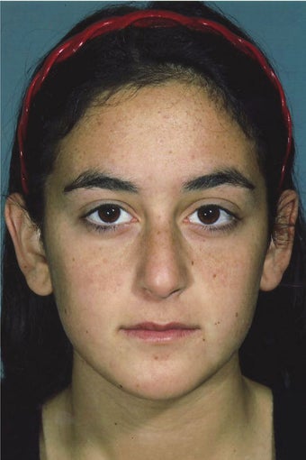 Rhinoplasty before 327037