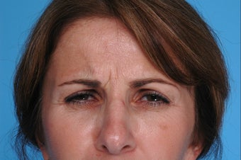 Botox before 506653