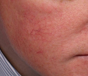 Vein treatment with V Beam before 135896