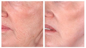 Wrinkle treatment near mouth before 6409