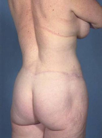 Lower body lift after 109948