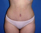 Abdominoplasty Surgery after 130047