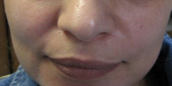 Juvederm before 272080
