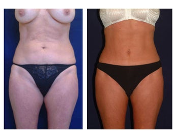 Tummy Tuck / Abdominoplasty before 55019