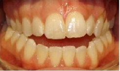Invisalign Treatment before 359168
