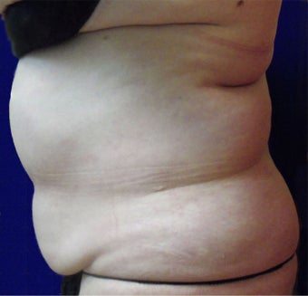 VASER Shape to Abdomen before 433051