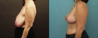 Breast Reduction after 160575