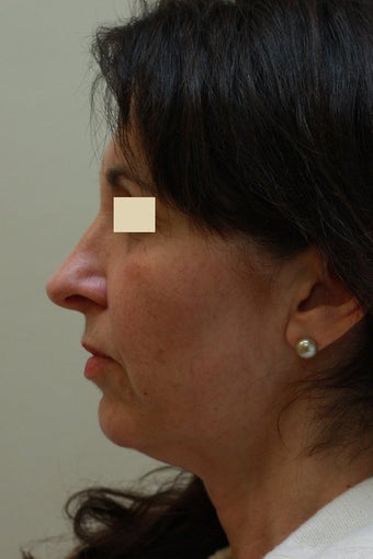 Face Lift (side view) before 102549