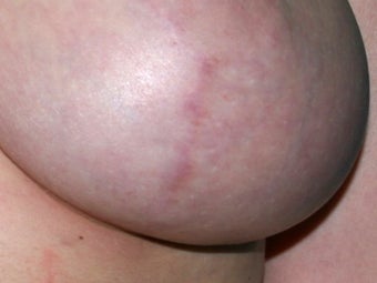 Breast implant scar removal before 376097