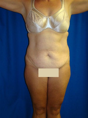 Abdominoplasty Surgery before 151308