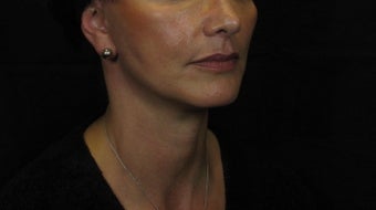 Laser Rhytidectomy (Facelift) after 222726