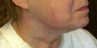 Thermage before 272047