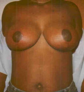Breast Reduction after 167171