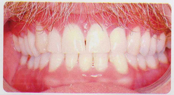 Low incisor extraction after 353445