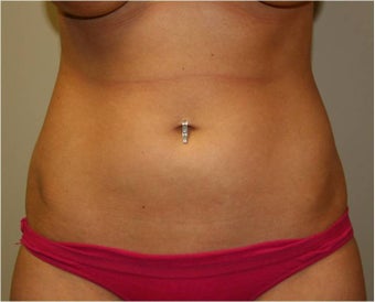 SmartLipo Love Handles Anterior View after 109442