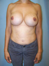 Revisionary Breast Surgery before 96804
