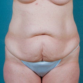Tummy Tuck before 313076