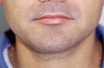 Neck Liposuction after 68523