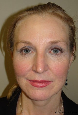 Facelift with browlift and lower blephorplasty after 617176