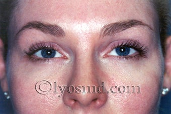 Endoscopic Browlift and CO2 Laser Resurfacing - Facelift after 224618