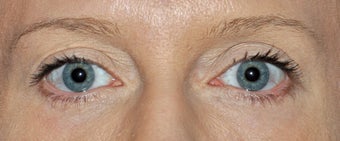 Blepharoplasty after 521700
