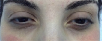 PRP (platelet rich plasma) before 570929