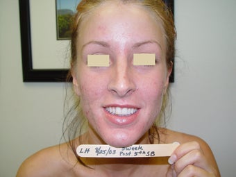 SmoothBeam Laser for Acne after 152217