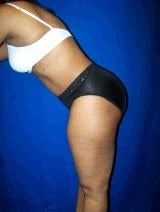 Tummy Tuck (Abdominoplasty) 428737