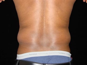 Liposuction of Abdomen, Waist, Flanks with 6 Pack Abdominal Etching before 203527